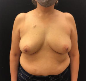 Fat Grafting to Breast