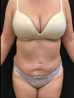 Tummy Tuck