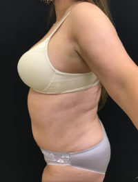 Tummy Tuck