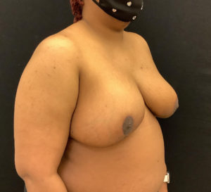Breast Reduction