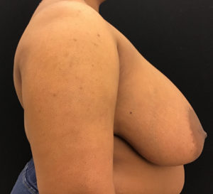 Breast Reduction