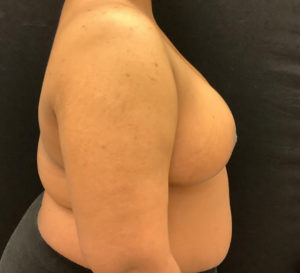 Breast Reduction