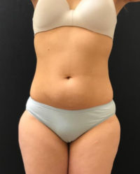 Liposuction