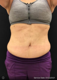 Tummy Tuck