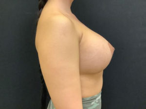 Breast Augmentation