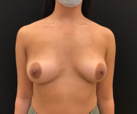 Breast Augmentation