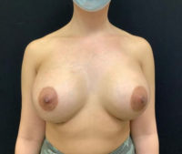 Breast Augmentation