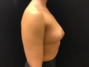 Breast Augmentation