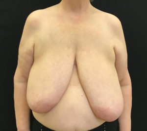 Breast Reduction
