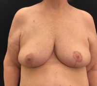 Breast Reduction