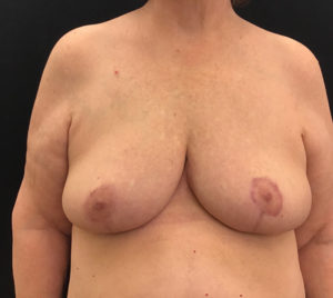 Breast Reduction