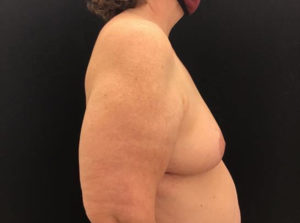 Breast Reduction
