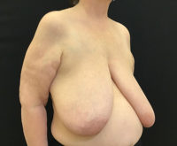 Breast Reduction