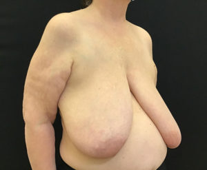 Breast Reduction