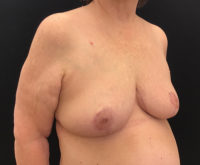 Breast Reduction