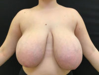 Breast Reduction