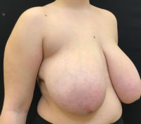 Breast Reduction