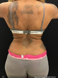 Liposuction