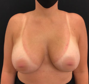 Breast Augmentation