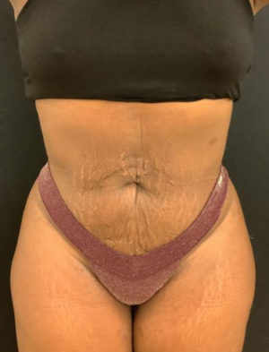 Liposuction