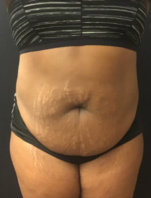 Liposuction