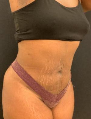 Liposuction