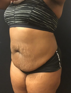 Liposuction