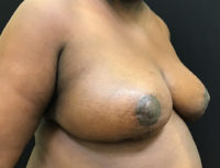 Breast Reduction