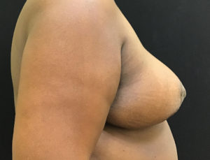 Breast Reduction