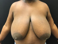 Breast Reduction
