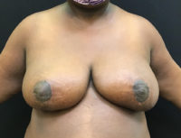 Breast Reduction