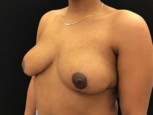 Breast Reduction
