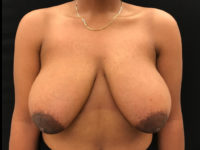 Breast Reduction