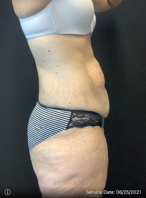 Tummy Tuck