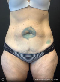 Tummy Tuck