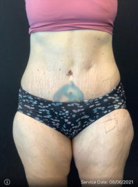 Tummy Tuck