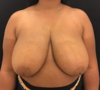 Breast Reduction