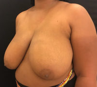 Breast Reduction