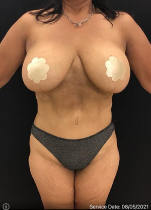 Breast Augmentation