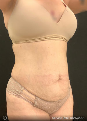 Tummy Tuck