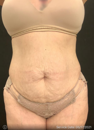 Tummy Tuck