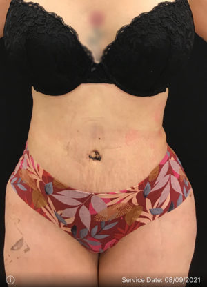 Tummy Tuck