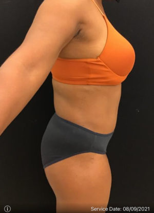 Tummy Tuck