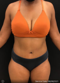 Tummy Tuck