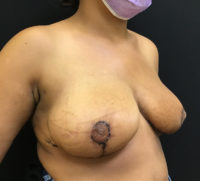Breast Reduction