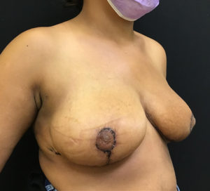 Breast Reduction