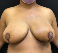 Breast Reduction