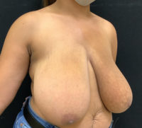 Breast Reduction