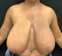 Breast Reduction