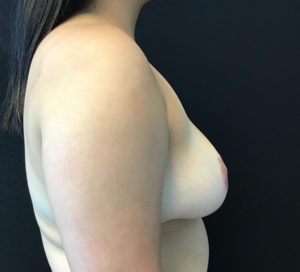 Breast Reduction